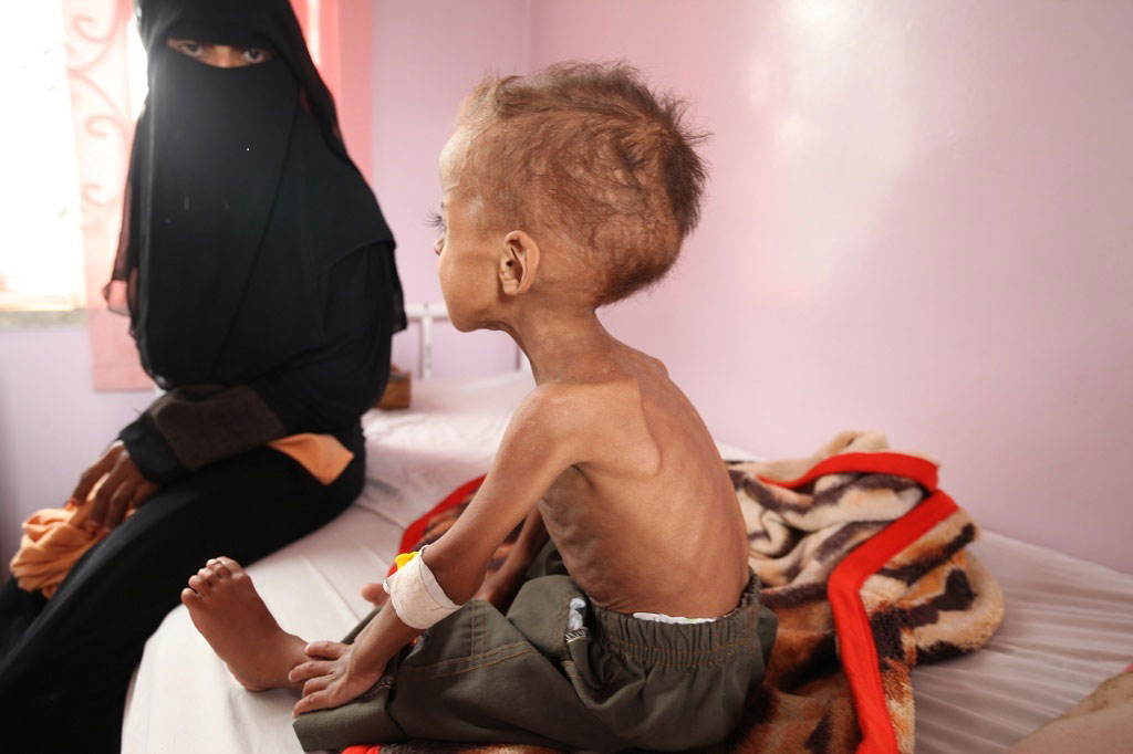 يعاني فيصل، 18 شهرا من العمر من سوء التغذية الحاد. مستشفى السبعين في العاصمة اليمنية صنعاء. المصدر: اليونيسف / UMI191723 / ياسين