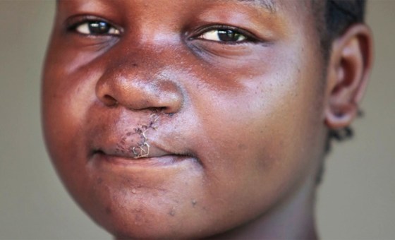 15-year old Agnes from Tanzania says an operation to correct a cleft lip has changed her life.